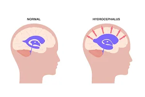 Hydrocephalus